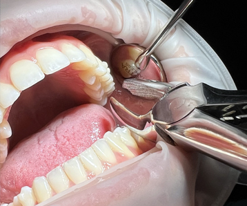 Cirugía oral