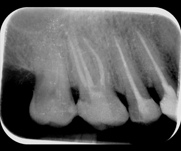 Endodoncia